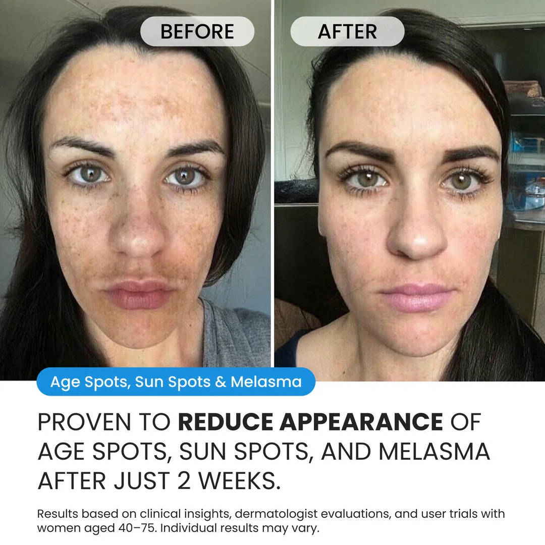 Dark Spot Corrector for Dark Spots, Melasma & Uneven Skin Tone