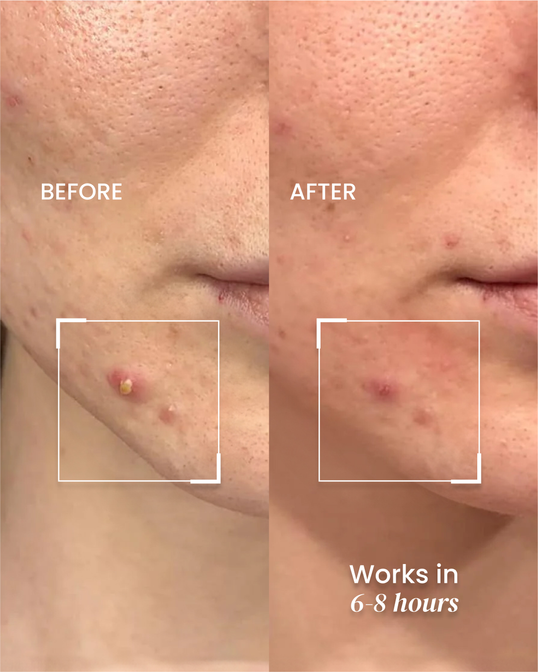 Daytime Pimple Patch