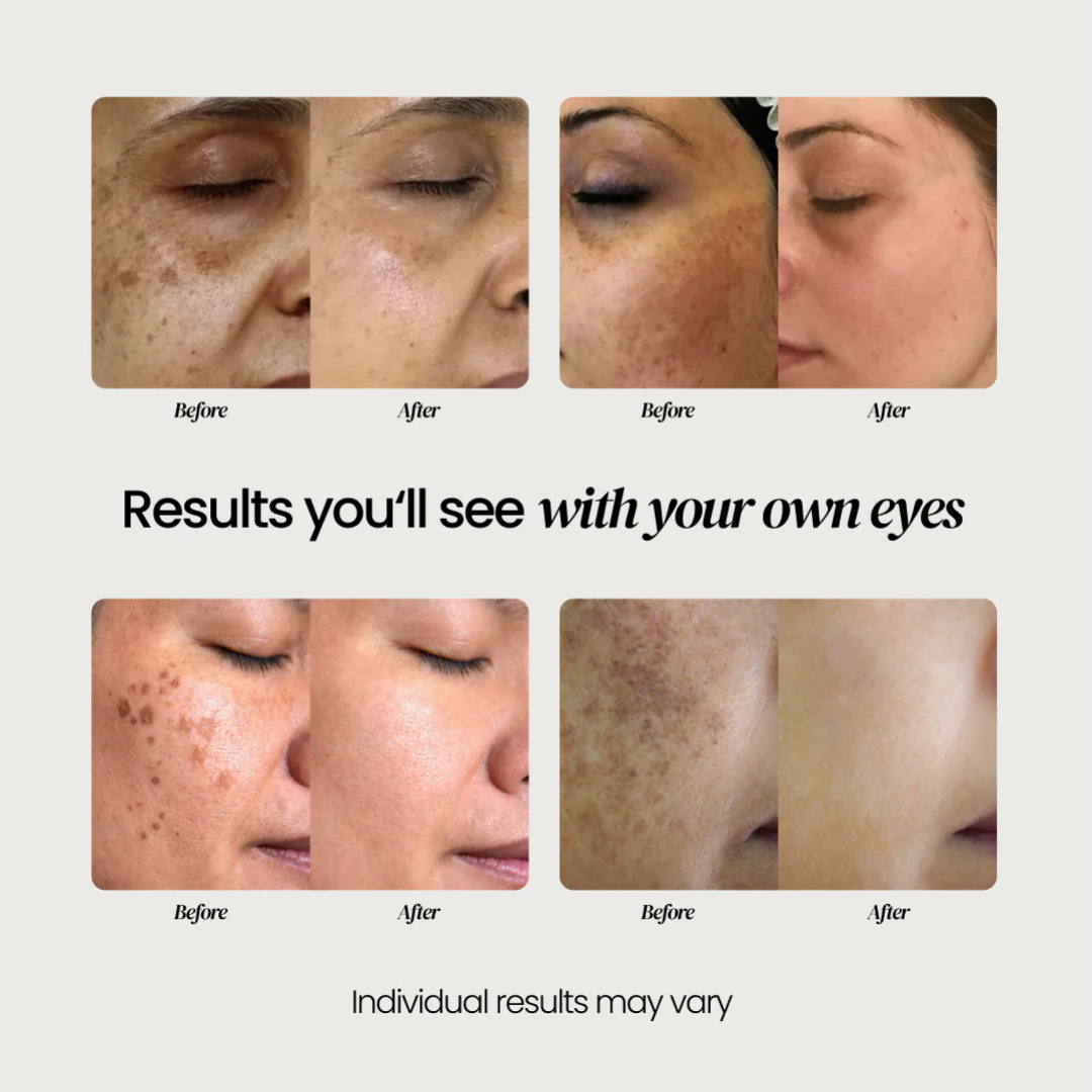 Dark Spot Corrector for Dark Spots, Melasma & Uneven Skin Tone