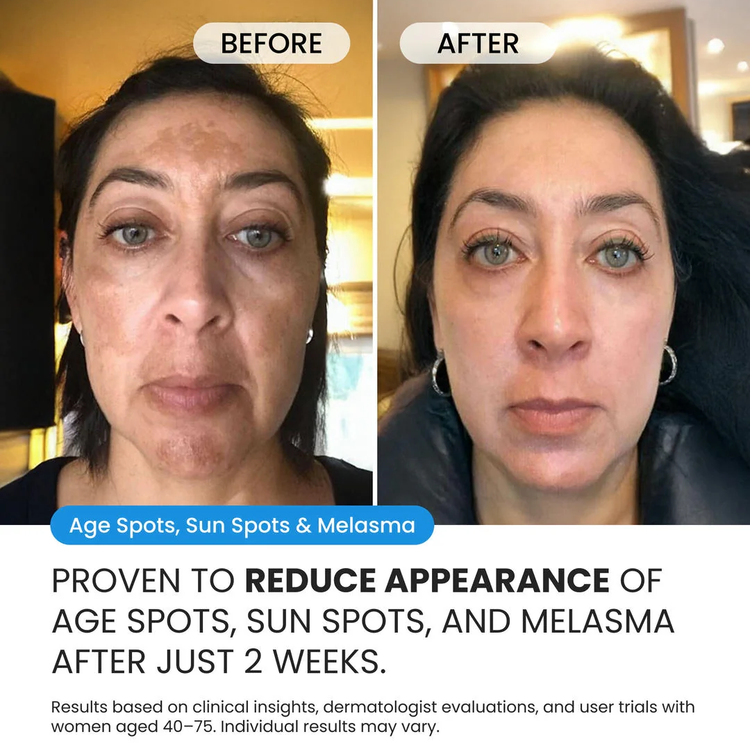 Dark Spot Corrector for Dark Spots, Melasma & Uneven Skin Tone