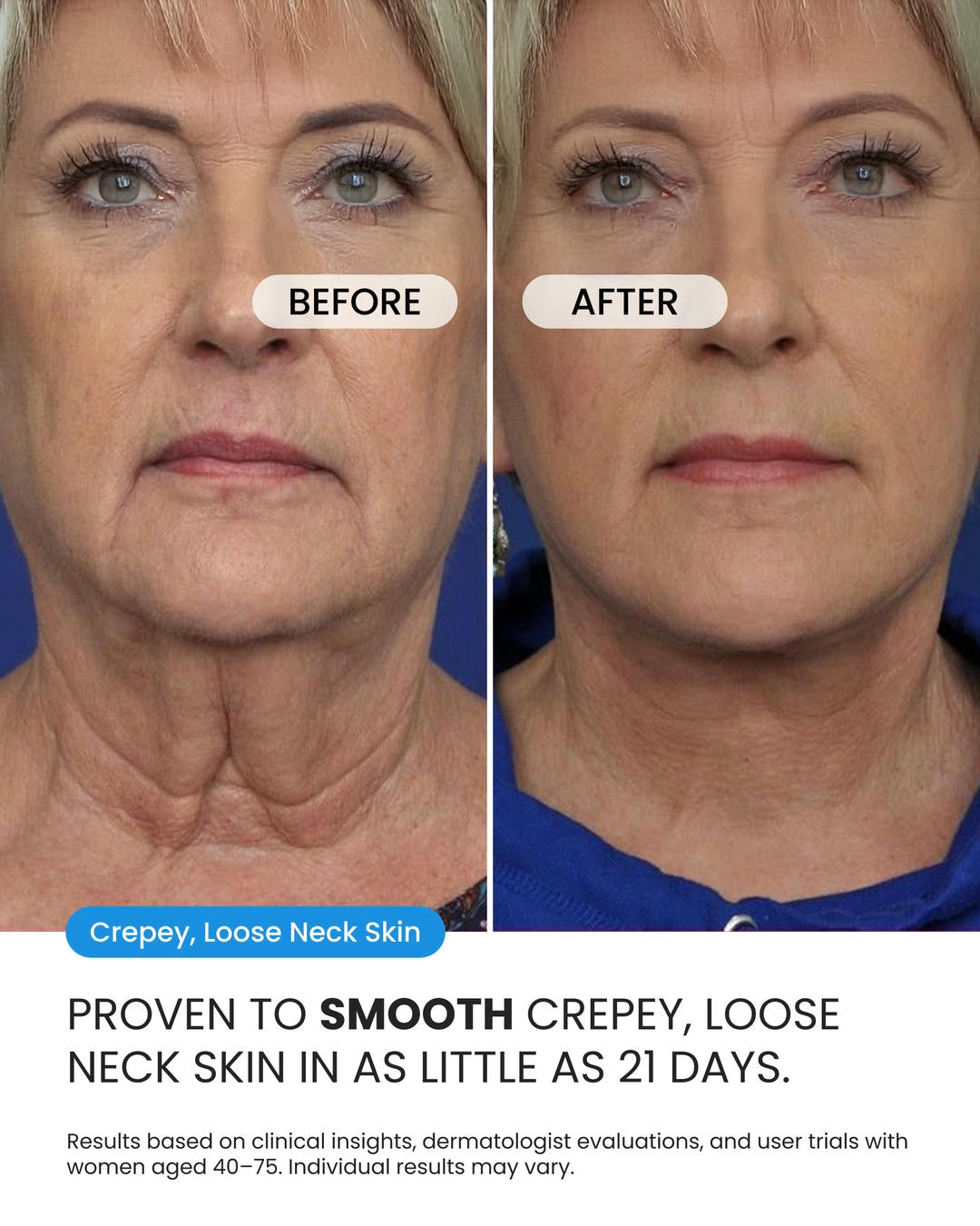 Neck Cream for sagging skin, deep creases and neck lines