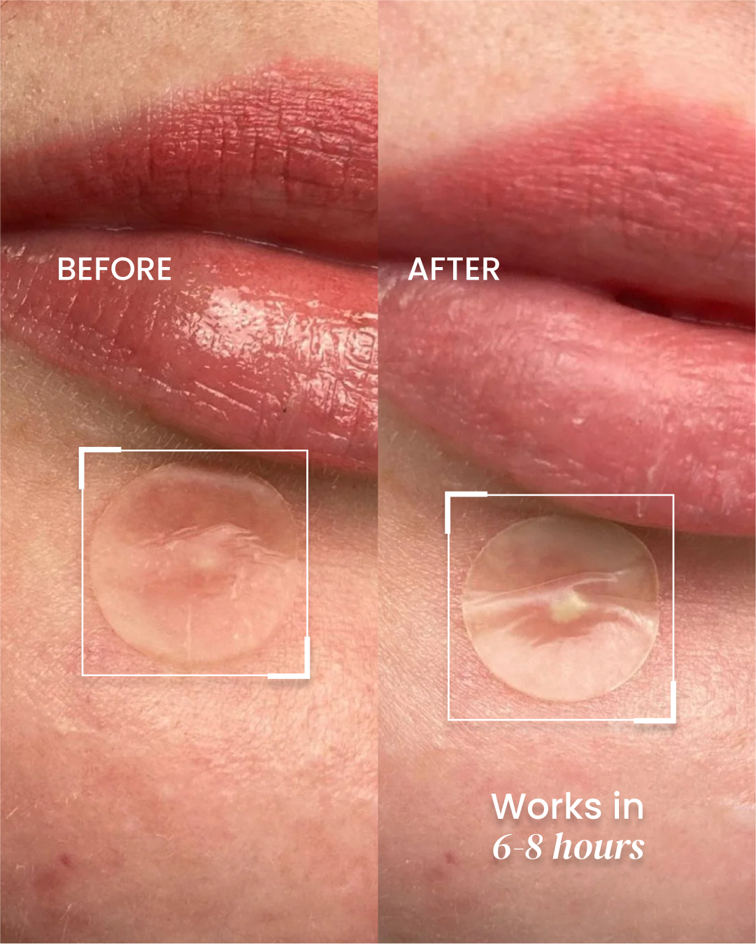 Nightime Pimple Patch