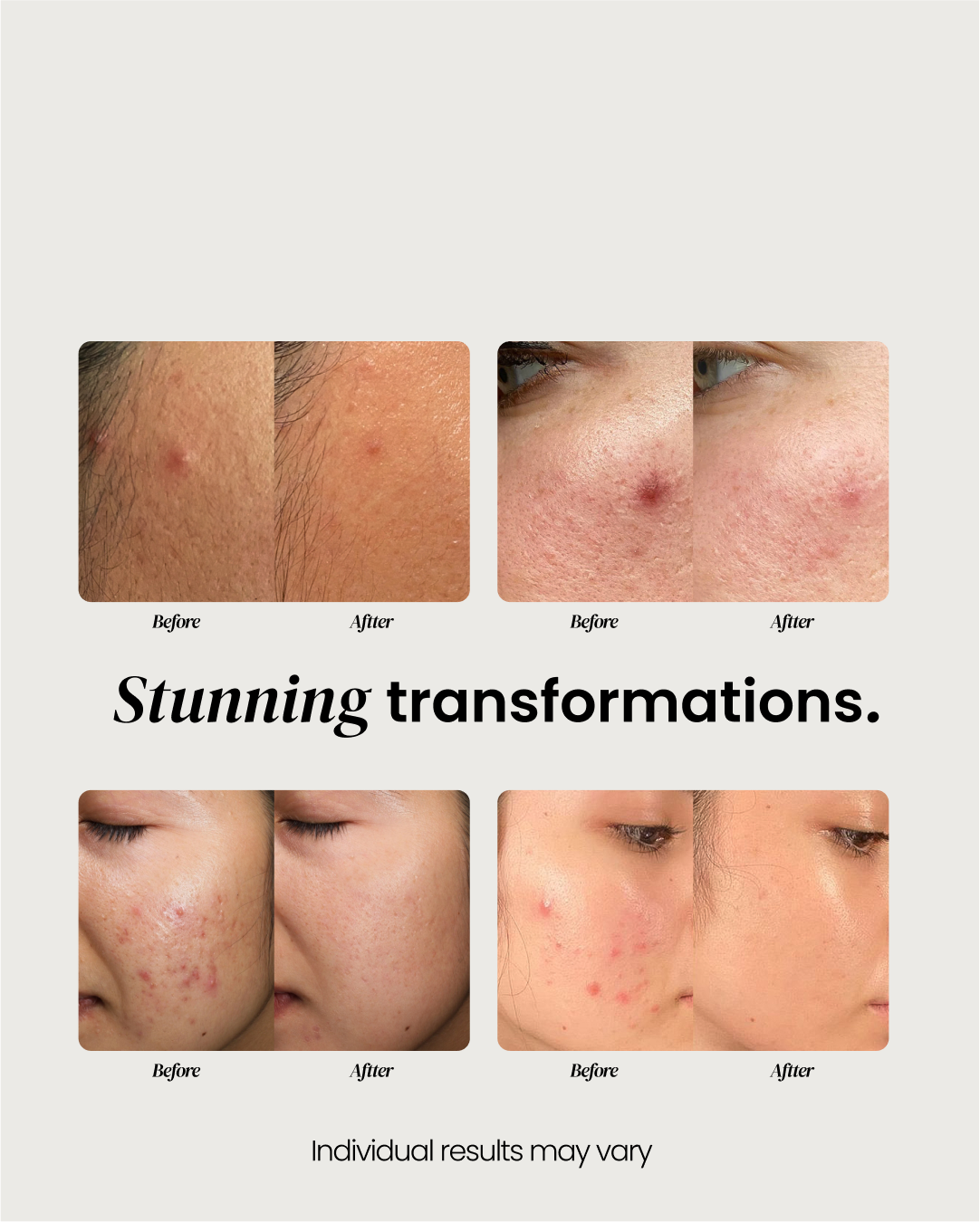 Nightime Pimple Patch